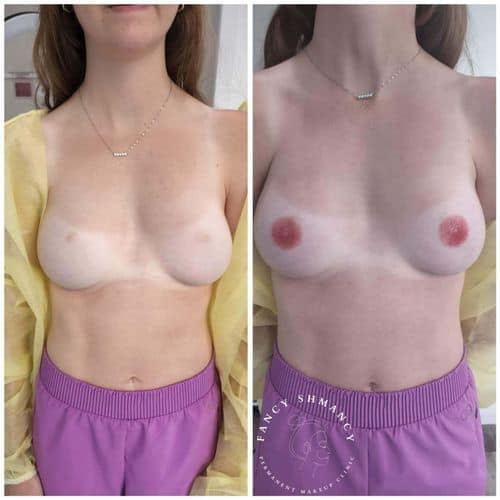 nipple-areola-correction-3d-areola-tatoo