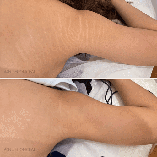 stretch-marks-camouflage-pigmentations